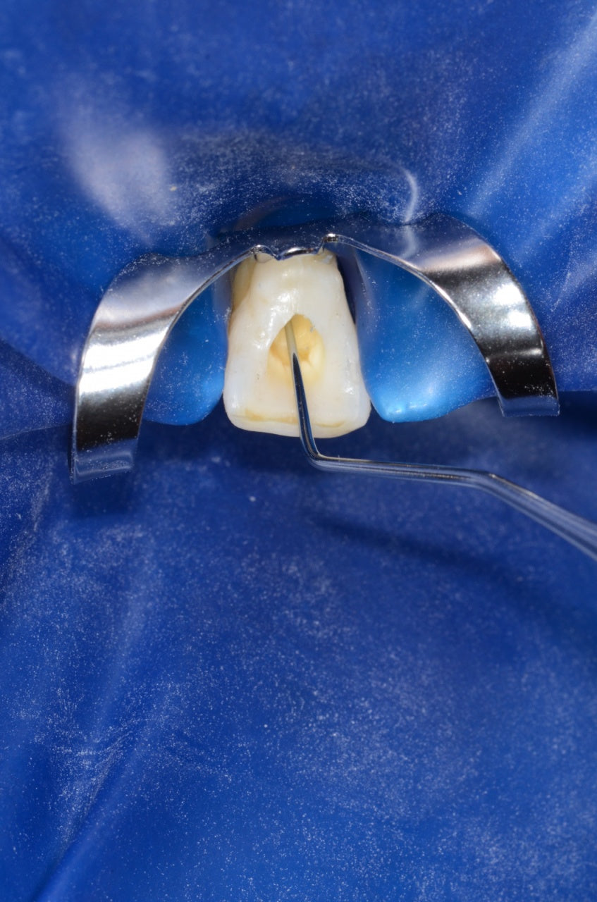 9214 - Sonda endo model 17/17L - KOHLER Dental - imaginea 3