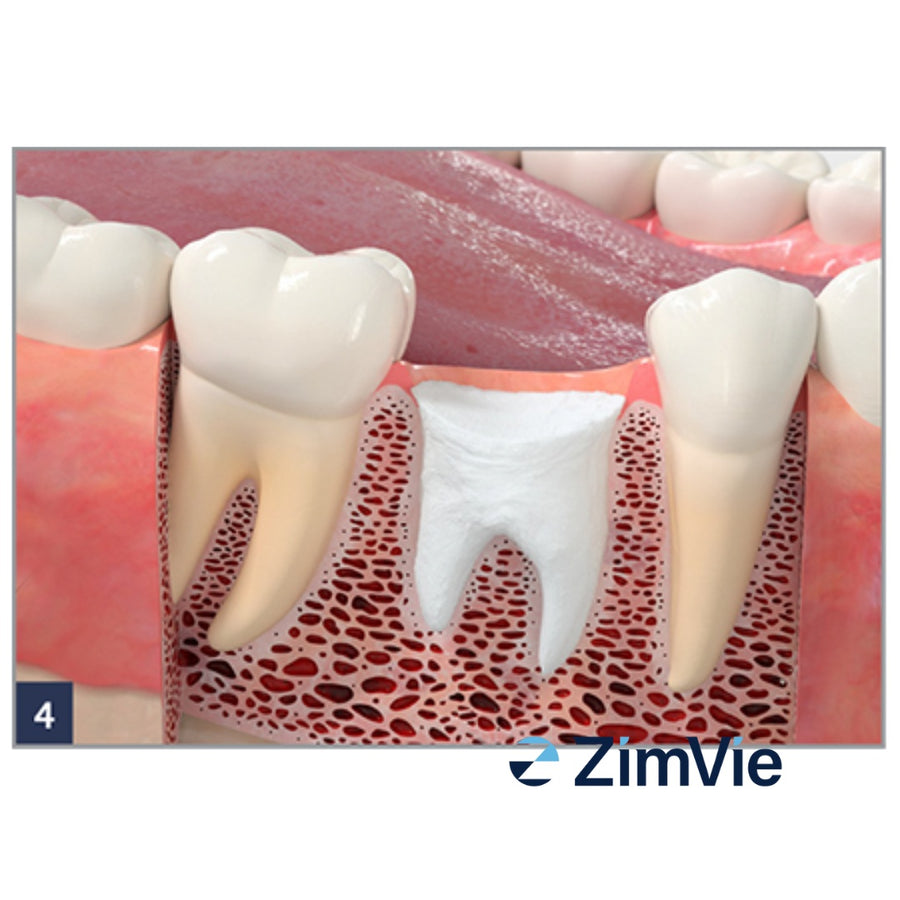 Dop Hemostatic Resorbabil ZimVie Collagen Plug (0102Z) – 10 buc. - imaginea 5