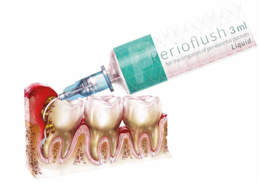 Perio-Flush Kit ( 10 × 3 ml ) – Soluție profesională pentru irigarea pungilor parodontale - ARKONA - imaginea 8