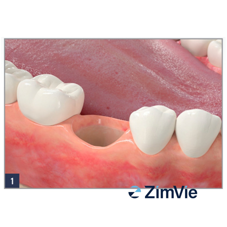 Dop Hemostatic Resorbabil ZimVie Collagen Plug (0102Z) – 10 buc. - imaginea 2