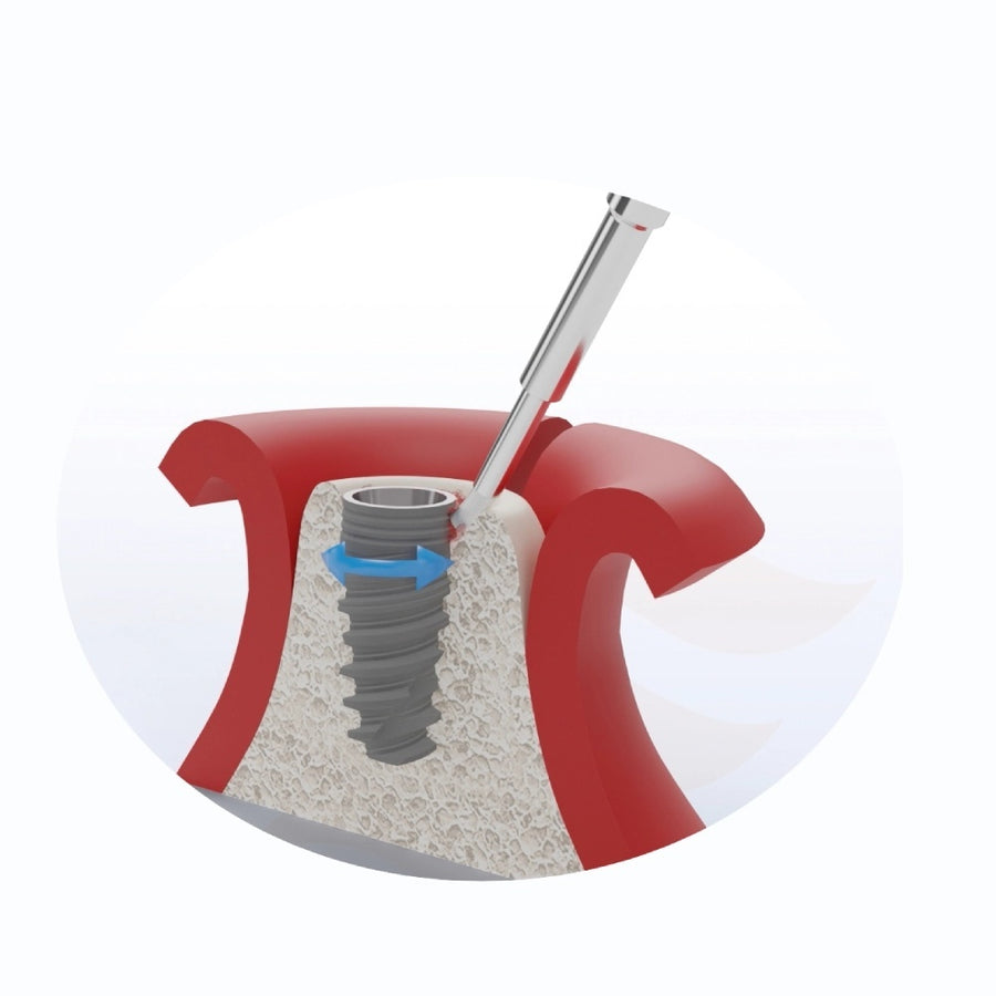 Titanium Brush pentru Implanturi Dentare – Perie pentru Decontaminare în Tratamentul Peri-implantitei - imaginea 3