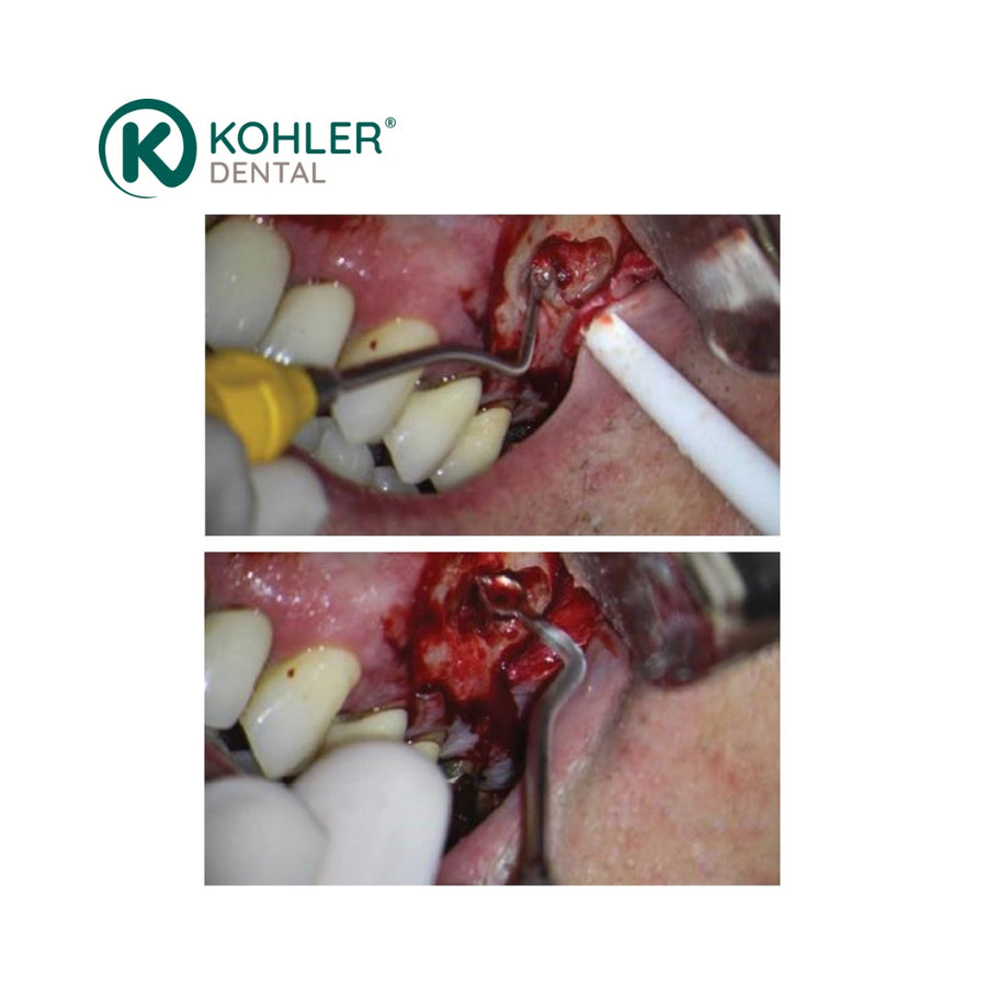 3306 - Instrument pentru Țesut de Granulație, 4 mm - Dr. Sabeti, PEEK Green (Versiune Scurtă și Lungă) - KOHLER Dental - imaginea 3