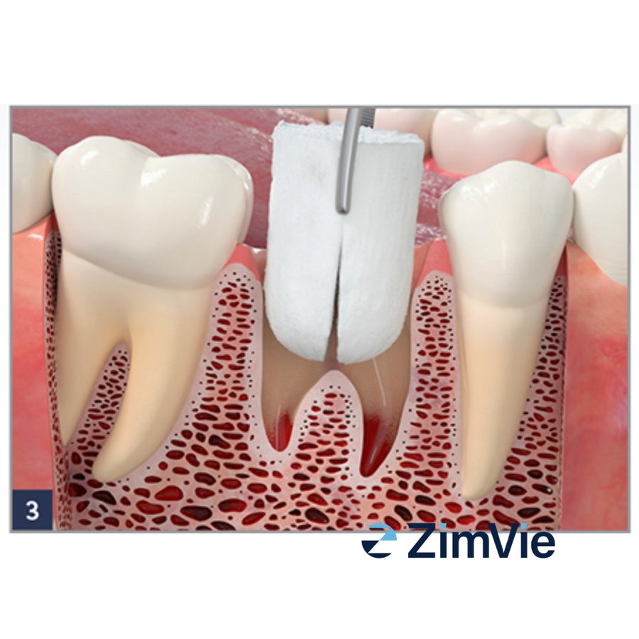 Dop Hemostatic Resorbabil ZimVie Collagen Plug (0102Z) – 10 buc. - imaginea 4
