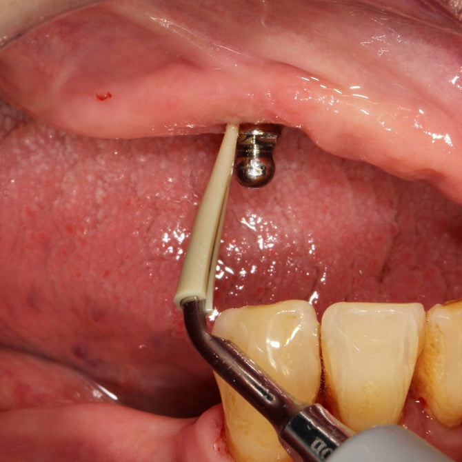 Rezerve de vârf Scorpion Ultrasonic CLiP PEEK – 5 bucăți - imaginea 4