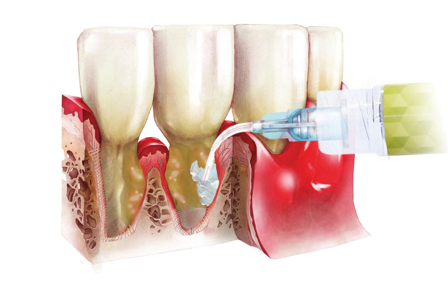 Perio-Flush Kit ( 10 × 3 ml ) – Soluție profesională pentru irigarea pungilor parodontale - ARKONA - imaginea 9