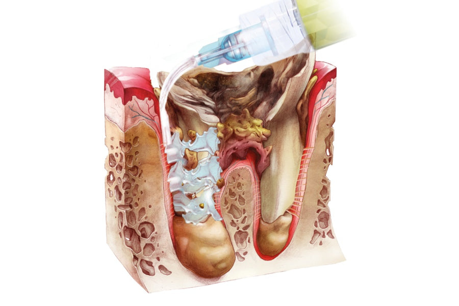 Perio-Flush Kit ( 10 × 3 ml ) – Soluție profesională pentru irigarea pungilor parodontale - ARKONA - imaginea 10