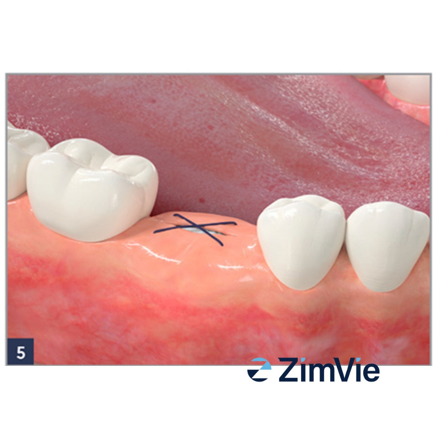 Dop Hemostatic Resorbabil ZimVie Collagen Plug (0102Z) – 10 buc. - imaginea 6