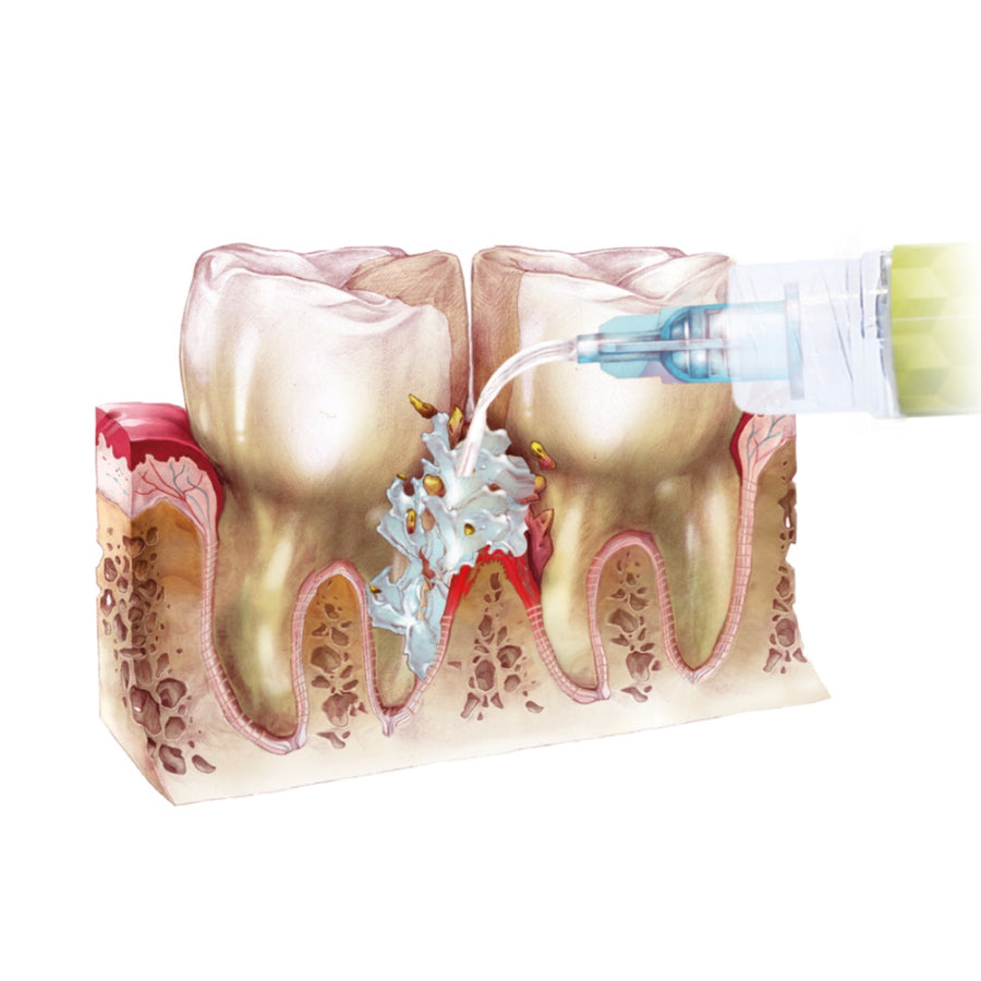 Perio-Flush Kit ( 10 × 3 ml ) – Soluție profesională pentru irigarea pungilor parodontale - ARKONA - imaginea 6