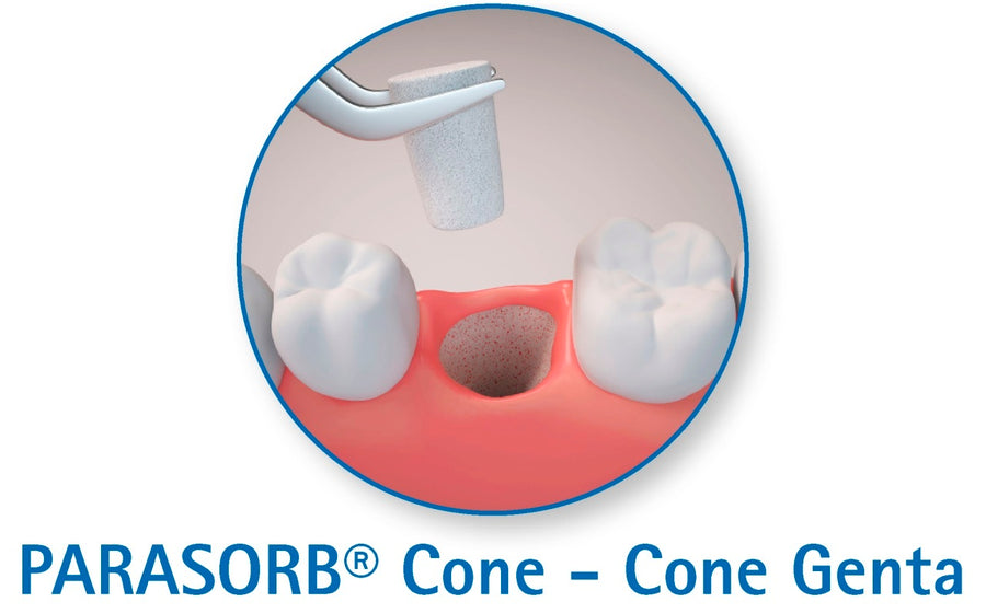 RESORBA PARASORB® Cone Genta MK11 – conuri hemostatice resorbabile din colagen cu gentamicină pentru alveola post-extracțională (10 buc.) - imaginea 3